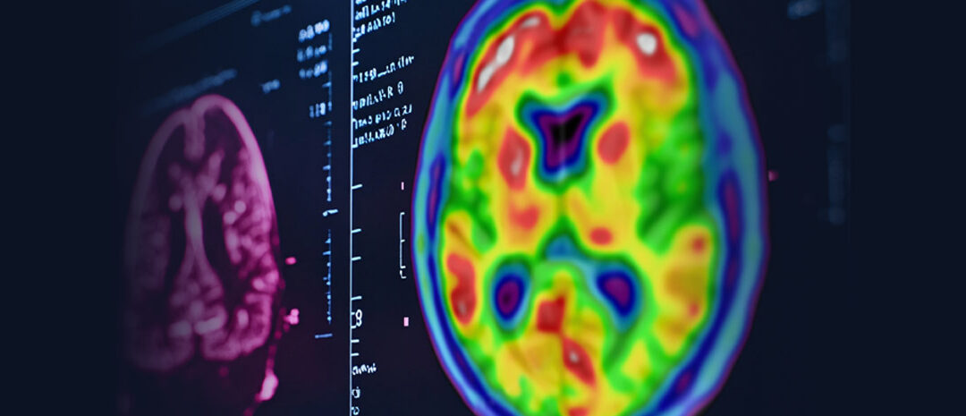 Amyloid PET Scan