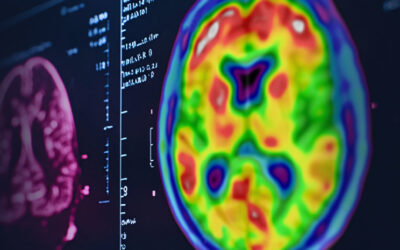 Amyloid PET Scan